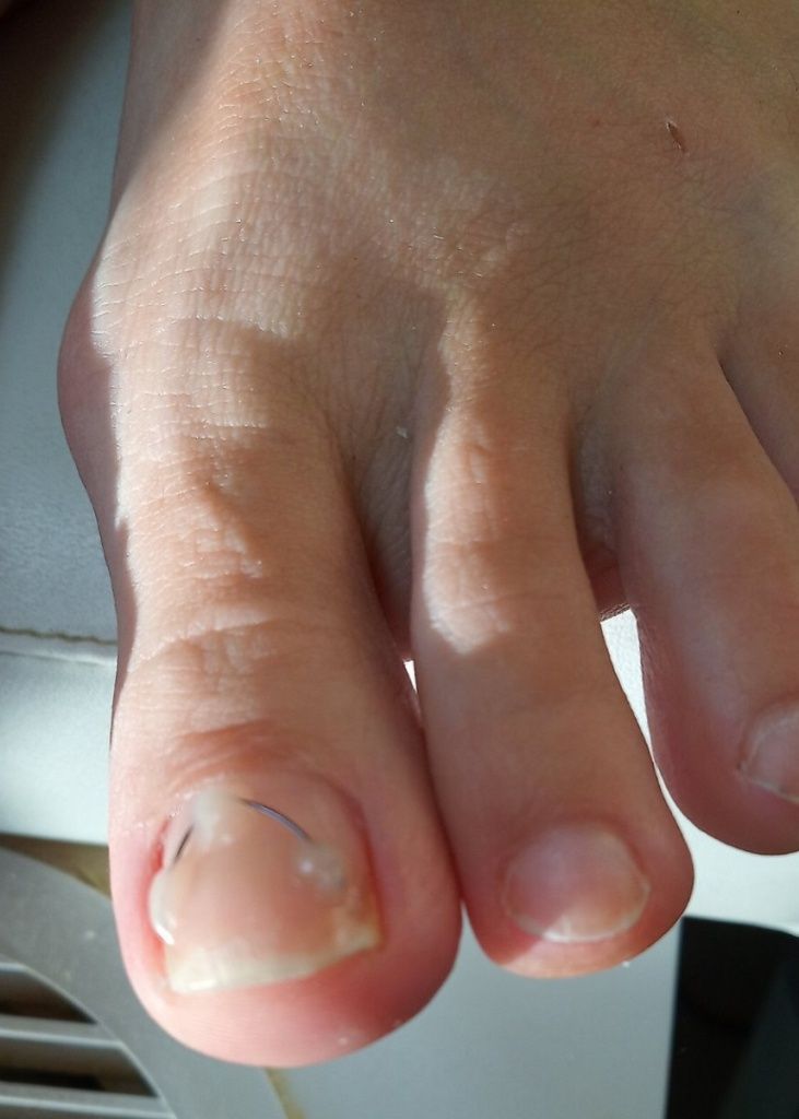 Лечение вросшего ногтя на ноге в нижнем новгороде thumbnail