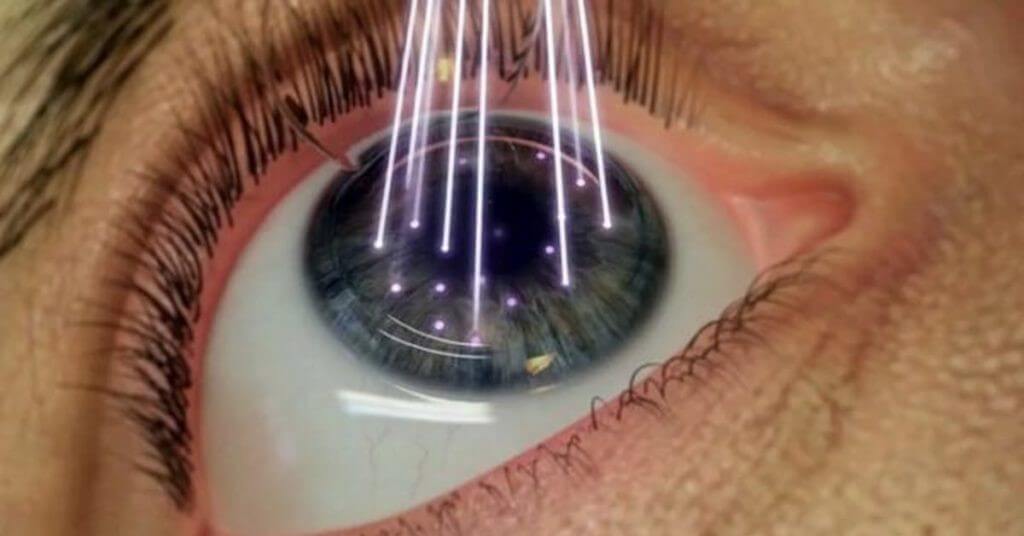 Как проходит лазерная коррекция зрения. Методики. Реабилитация