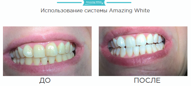 Фотоотбеливание зубов Amazing White