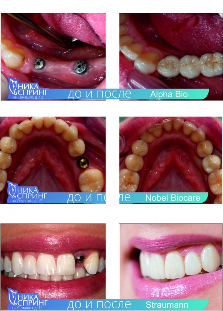 implantant-zubov-do-posle.jpg