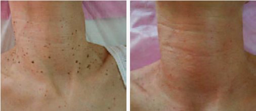 удаление родинок 2.jpg