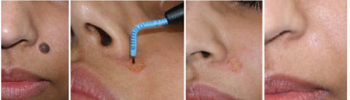 удаление родинок 1.jpg