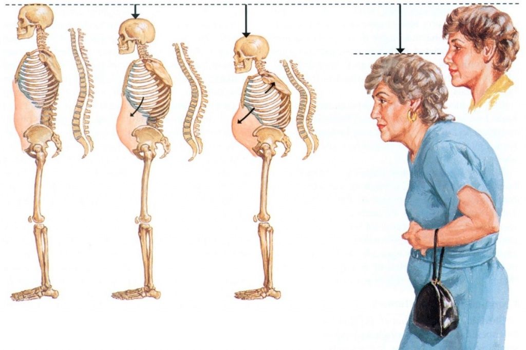 osteoporoz.jpg