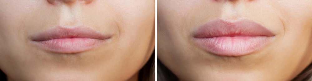 контурная пластика губы.jpg