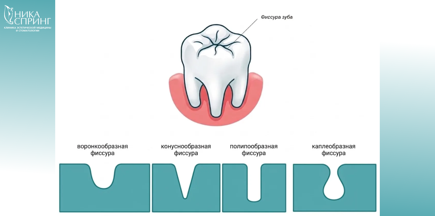 Фторирование, герметизация фиссур (1).png