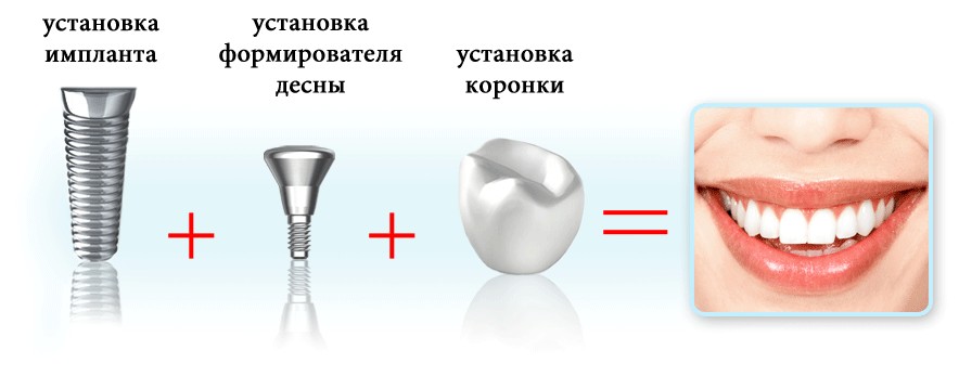 implantant-zubov-1.jpg