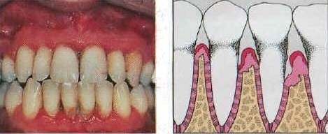 3-parodontit.jpg